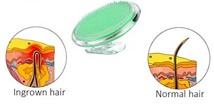 How to Get Rid of Ingrown Hairs with an Exfoliator Brush for Ingrown Hair